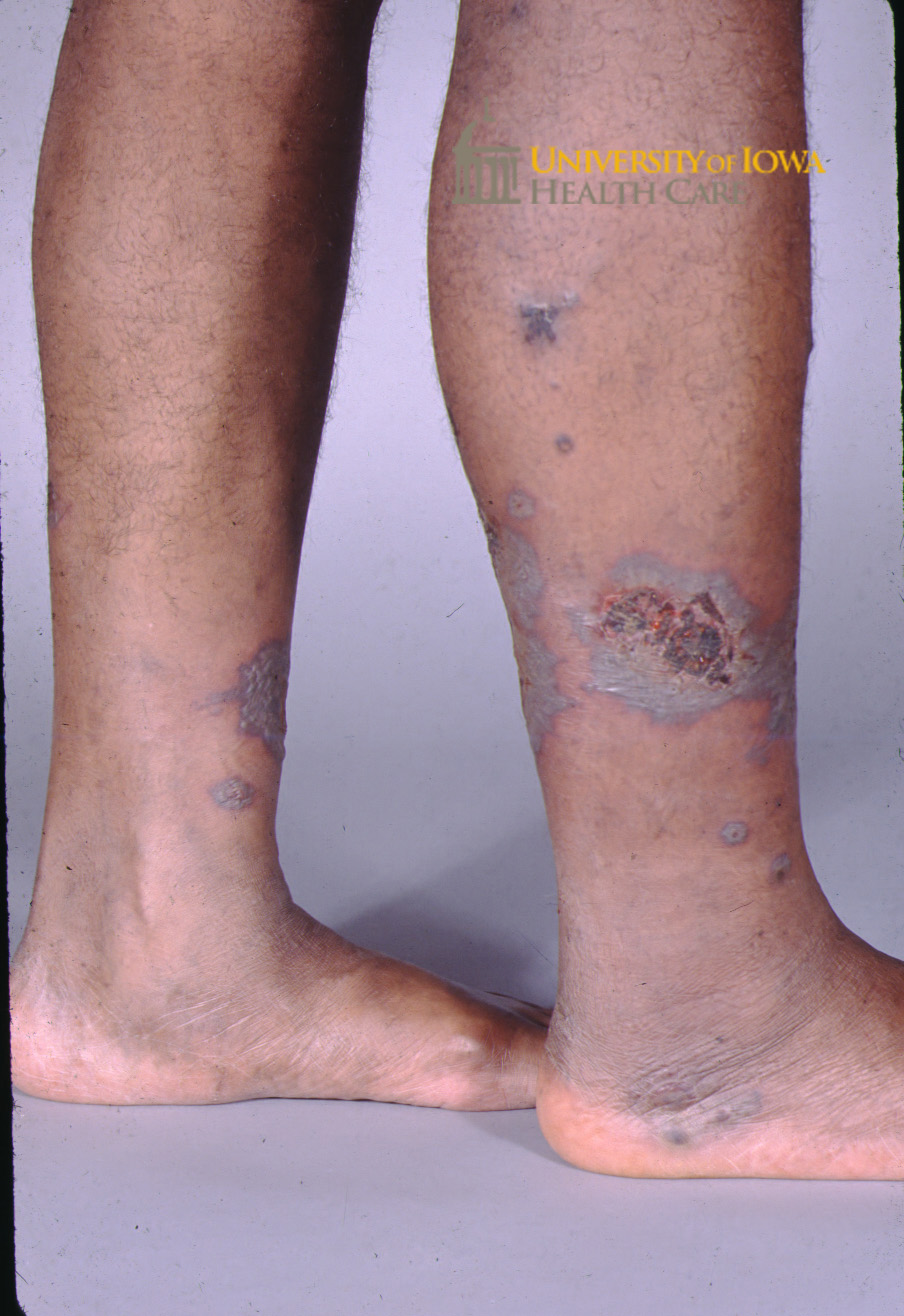 Violaceous retiform plaques with central ulceration and eschar on the lower legs. (click images for higher resolution).